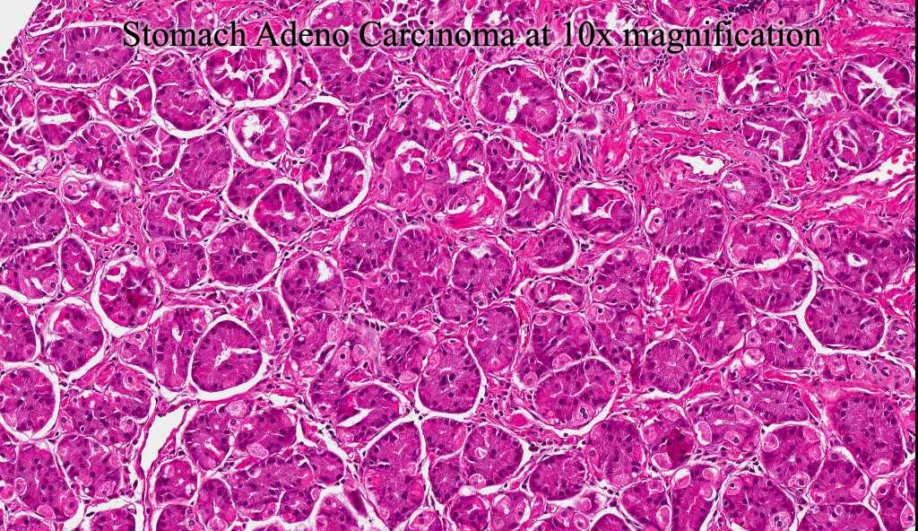 Stomach Adeno Carcinoma at 10x magnification